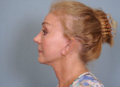 Facelift Before & After Patient #663