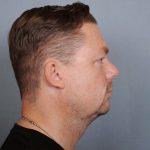 Chin Implants Before & After Patient #672