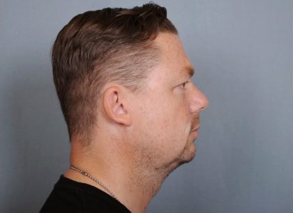 Chin Implants Before & After Patient #672