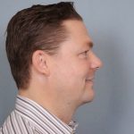 Chin Implants Before & After Patient #672