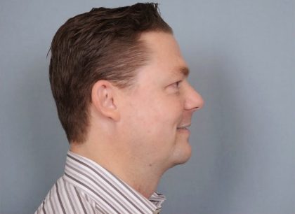 Chin Implants Before & After Patient #672