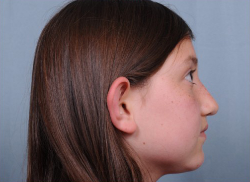 Otoplasty Before & After Patient #728