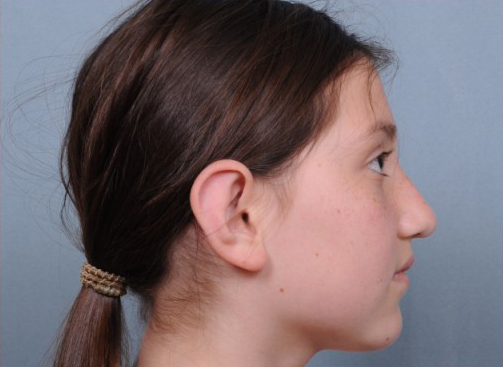 Otoplasty Before & After Patient #728