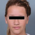 Otoplasty Before & After Patient #773