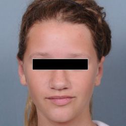 Otoplasty Before & After Patient #773