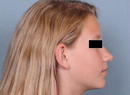 Otoplasty Before & After Patient #773