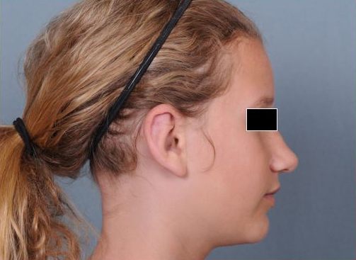 Otoplasty Before & After Patient #773