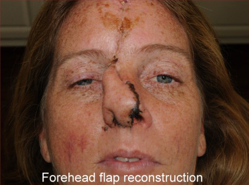 Reconstruction Before & After Patient #778
