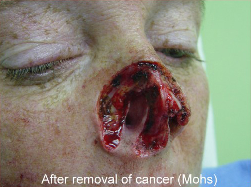 Reconstruction Before & After Patient #778