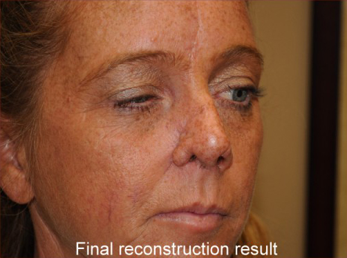 Reconstruction Before & After Patient #778