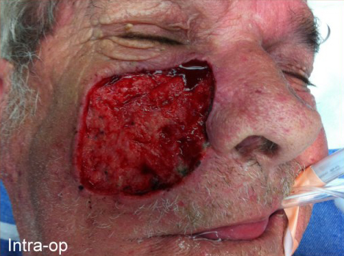 Reconstruction Before & After Patient #774