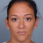 Otoplasty Before & After Patient #729