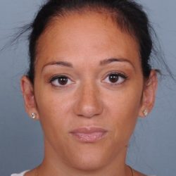 Otoplasty Before & After Patient #729