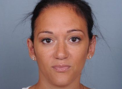 Otoplasty Before & After Patient #729