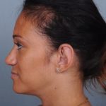 Otoplasty Before & After Patient #729