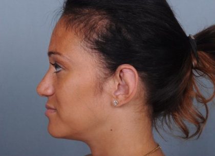 Otoplasty Before & After Patient #729