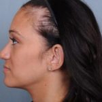 Otoplasty Before & After Patient #729