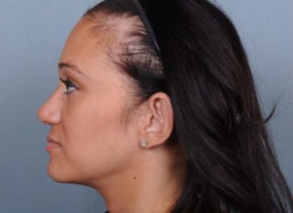 Otoplasty Before & After Patient #729