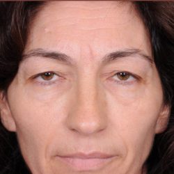 Blepharoplasty Before & After Patient #869