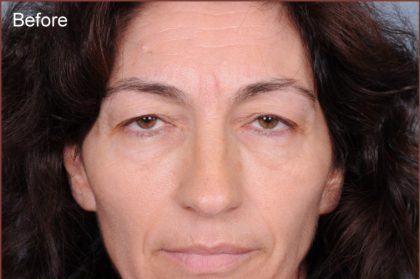 Blepharoplasty Before & After Patient #869