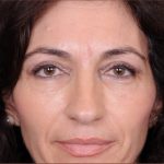 Blepharoplasty Before & After Patient #869