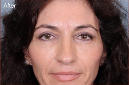 Blepharoplasty Before & After Patient #869