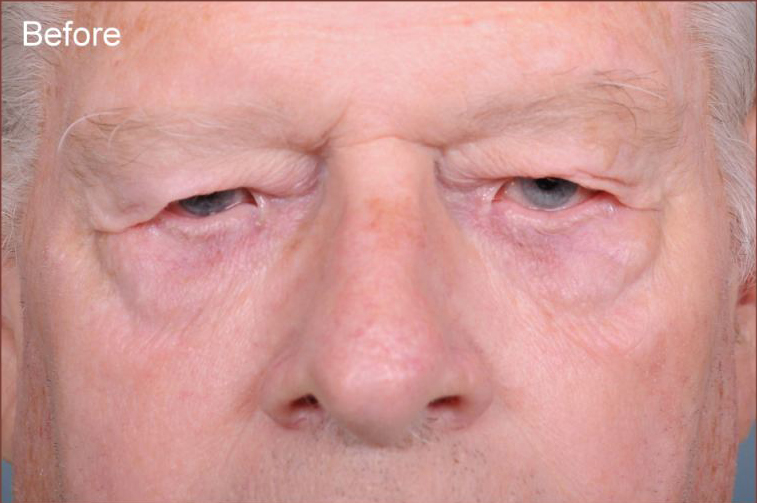 Blepharoplasty Before & After Patient #817