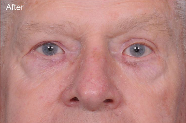 Blepharoplasty Before & After Patient #817