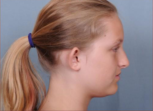 Otoplasty Before & After Patient #786