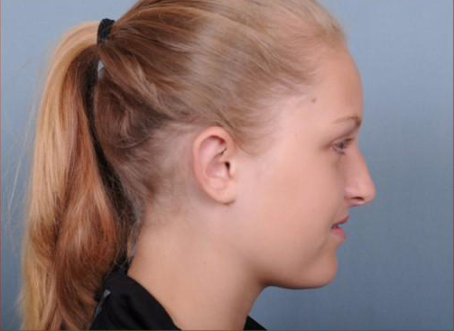 Otoplasty Before & After Patient #786