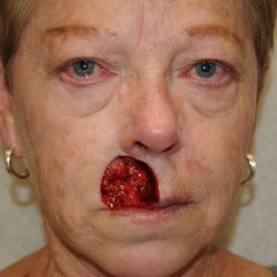 Reconstruction Before & After Patient #784