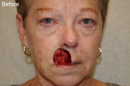 Reconstruction Before & After Patient #784