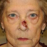 Reconstruction Before & After Patient #820