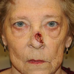 Reconstruction Before & After Patient #820