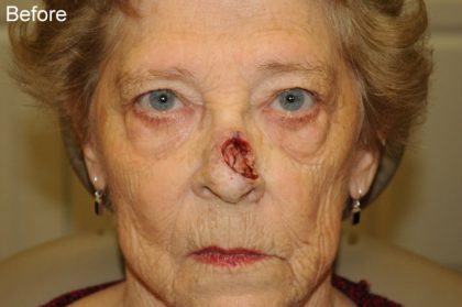 Reconstruction Before & After Patient #820