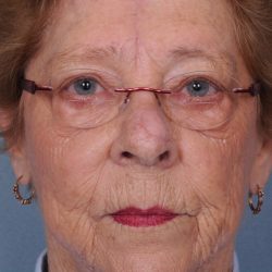 Reconstruction Before & After Patient #820