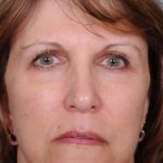 Blepharoplasty Before & After Patient #819