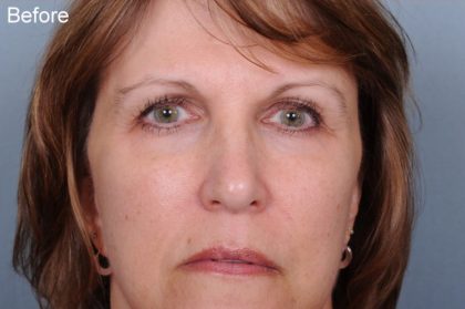Blepharoplasty Before & After Patient #819