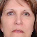 Blepharoplasty Before & After Patient #819
