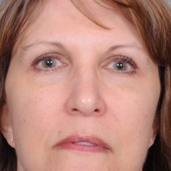 Blepharoplasty Before & After Patient #819