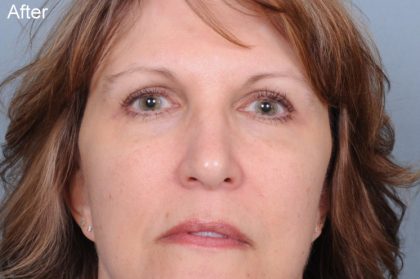 Blepharoplasty Before & After Patient #819