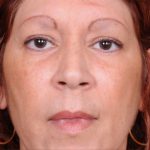Blepharoplasty Before & After Patient #788