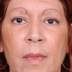 Blepharoplasty Before & After Patient #788