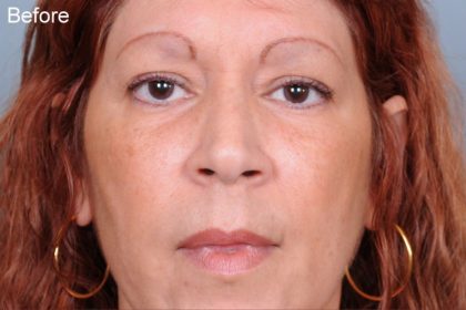Blepharoplasty Before & After Patient #788
