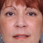 Blepharoplasty Before & After Patient #788