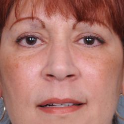 Blepharoplasty Before & After Patient #788