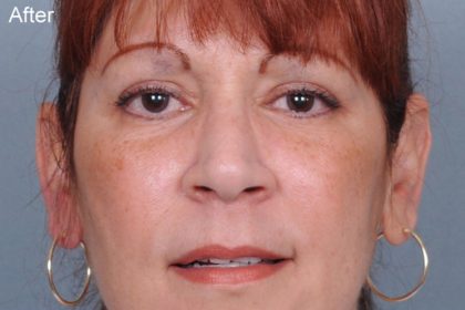 Blepharoplasty Before & After Patient #788