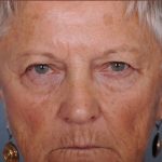 Blepharoplasty Before & After Patient #876