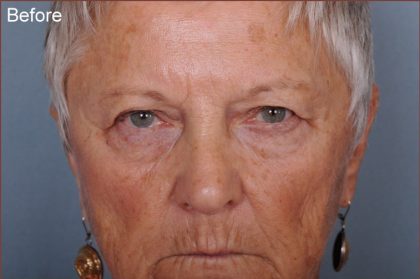 Blepharoplasty Before & After Patient #876