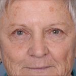 Blepharoplasty Before & After Patient #876